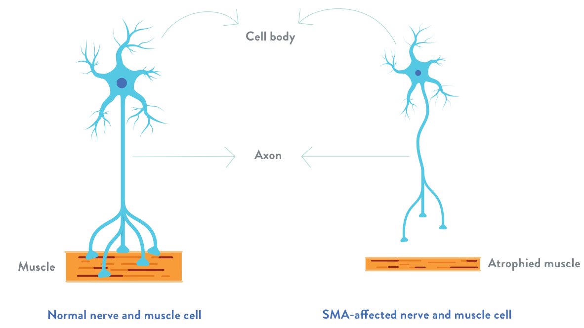 Spinal Muscular Atrophy SMN Protein